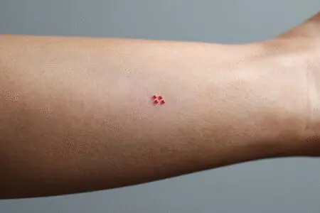 Prikaz treh rdečih pik v vrsti na koži ponazarja kako izgleda ugriz stenice